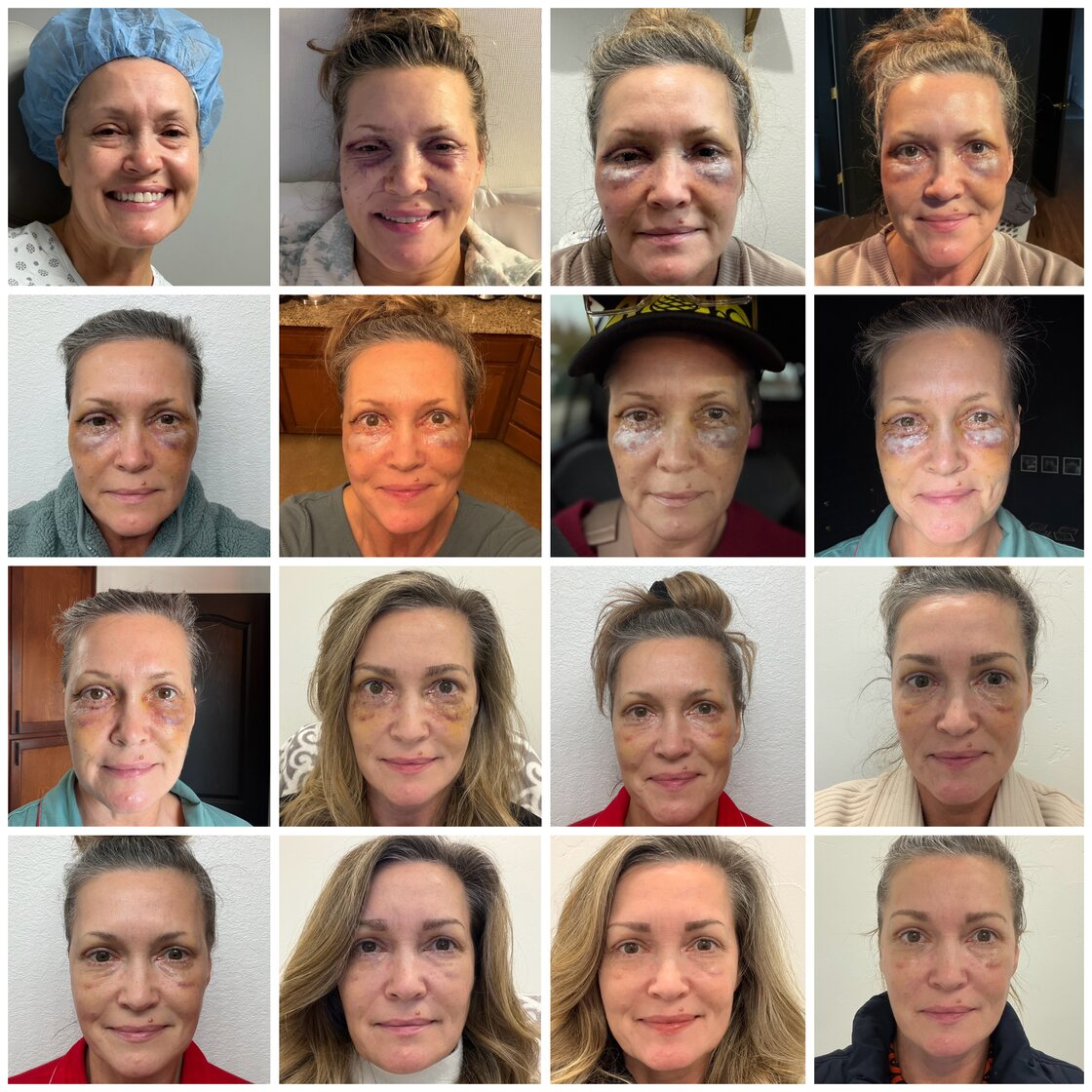 One patient's blepharoplasty recovery photographed daily across the first sixteen days, showing bruising peak around days two to four and steady resolution