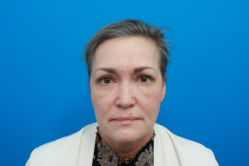 Eye area about one month after eyelid surgery, settled and rested