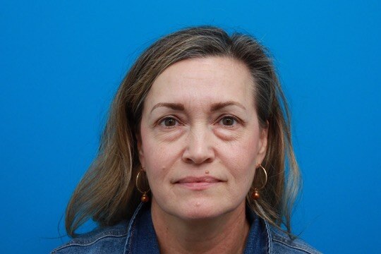 Patient before blepharoplasty, frontal view — upper eyelid hooding and under-eye fullness
