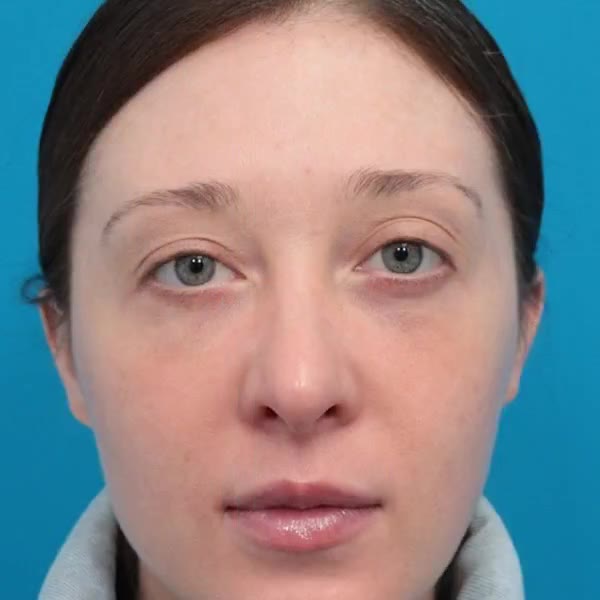 After: Lower blepharoplasty, facial fat transfer, nanofat & full-face CO₂ laser resurfacing