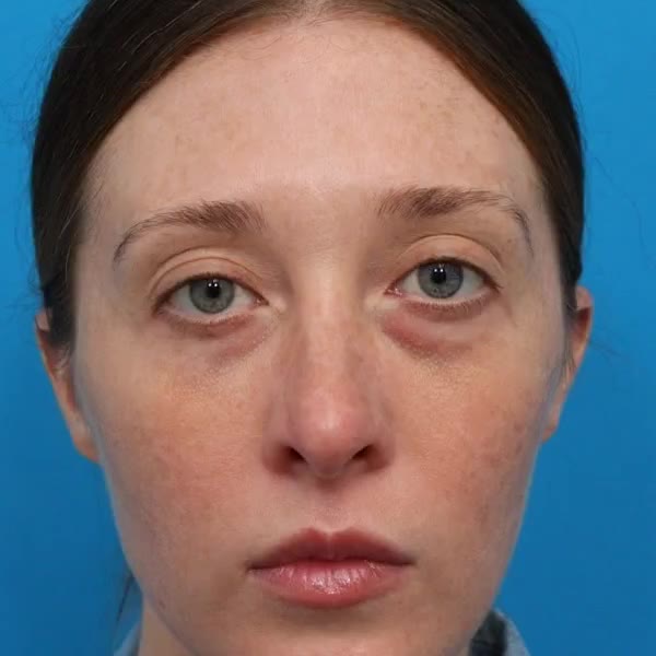 Before: Lower blepharoplasty, facial fat transfer, nanofat & full-face CO₂ laser resurfacing