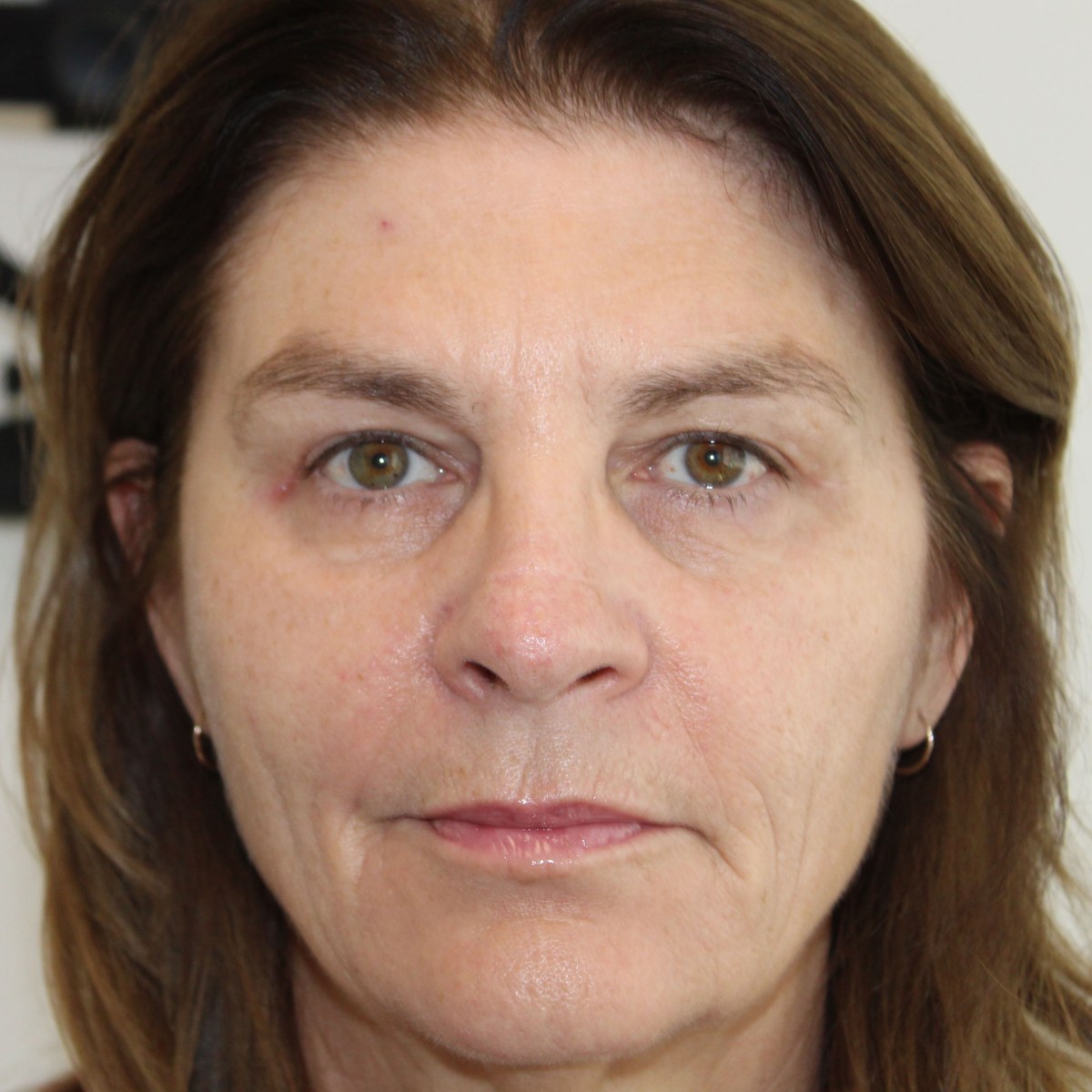 After: Endoscopic forehead lift, upper blepharoplasty & ptosis surgery