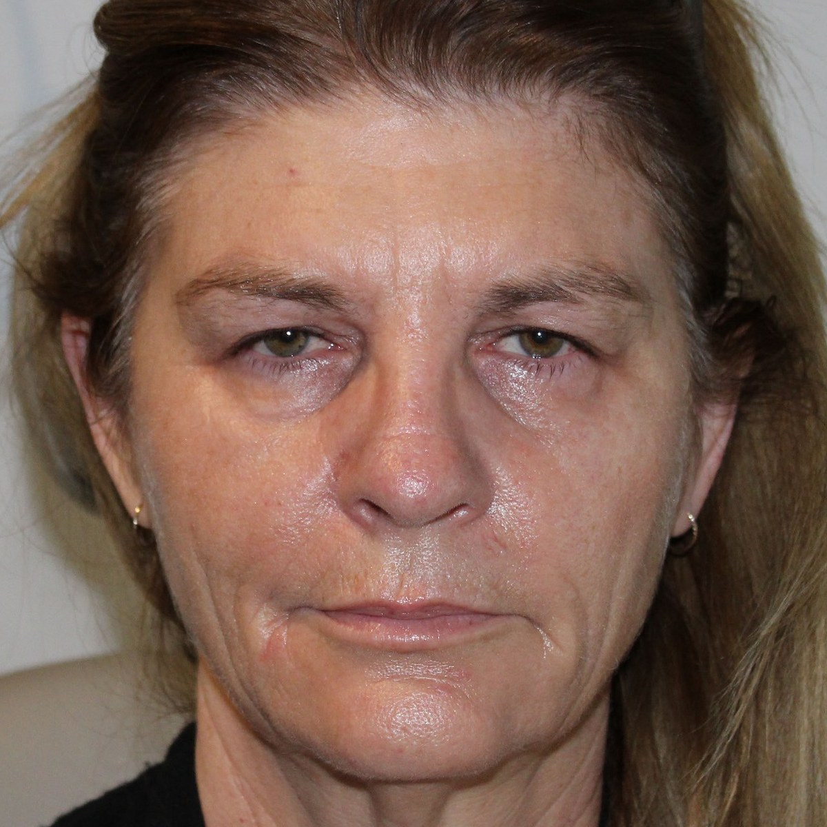 Before: Endoscopic forehead lift, upper blepharoplasty & ptosis surgery