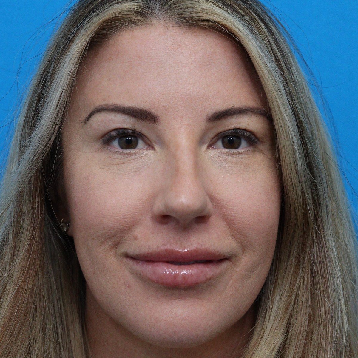 After: Lower blepharoplasty with facial fat transfer & lower-eyelid CO₂ laser resurfacing
