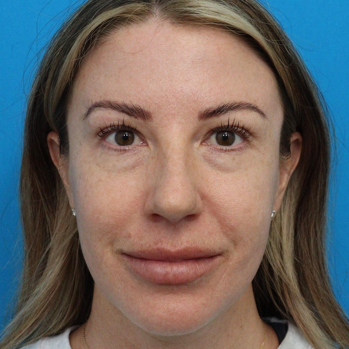 Before: Lower blepharoplasty with facial fat transfer & lower-eyelid CO₂ laser resurfacing