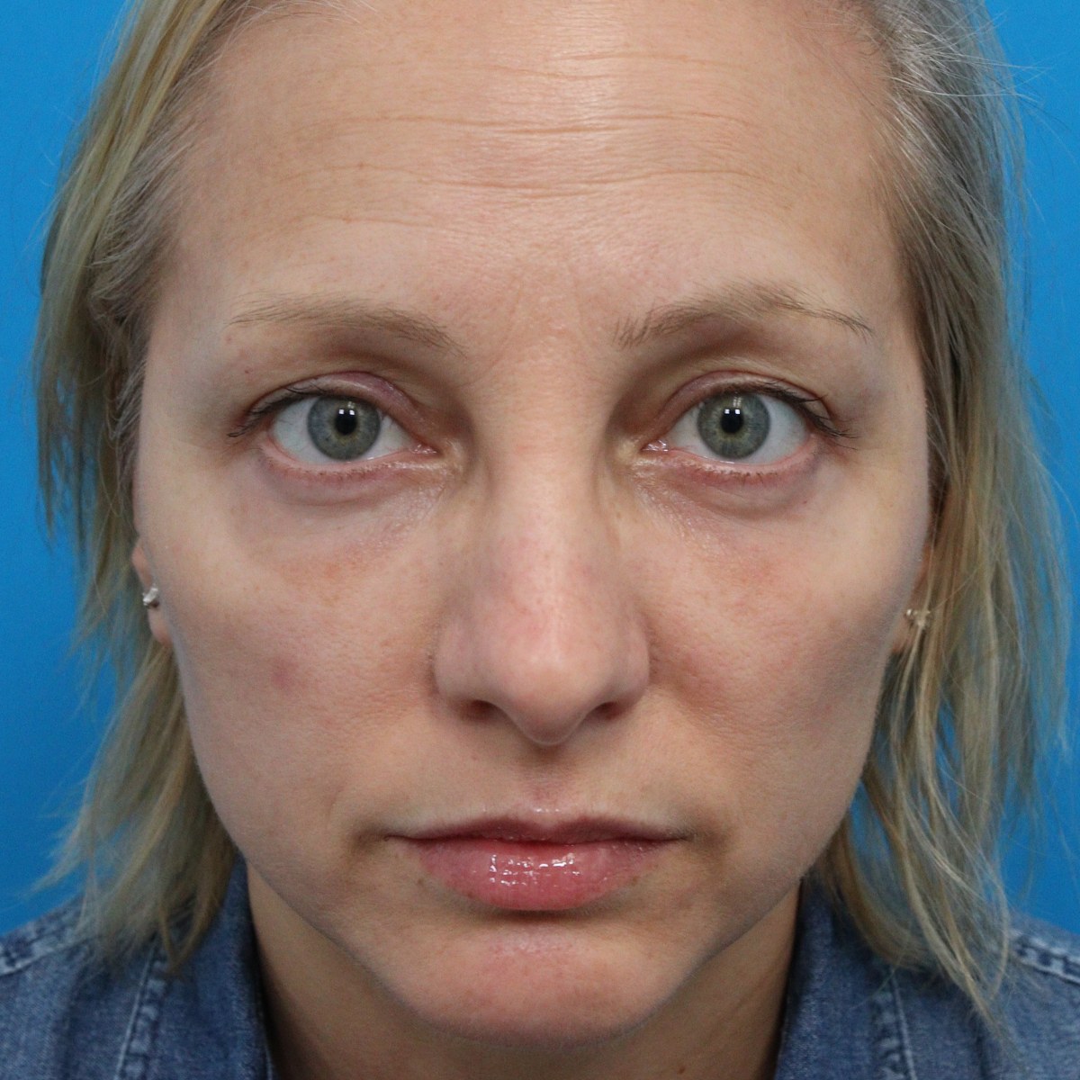 After: Upper & lower blepharoplasty, facial fat transfer, nanofat & lower-eyelid CO₂ laser resurfacing