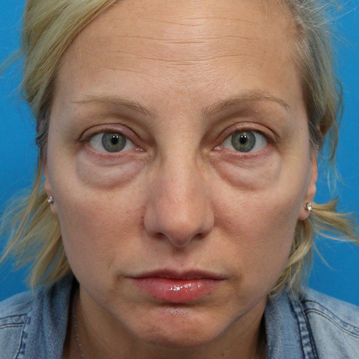 Before: Upper & lower blepharoplasty, facial fat transfer, nanofat & lower-eyelid CO₂ laser resurfacing