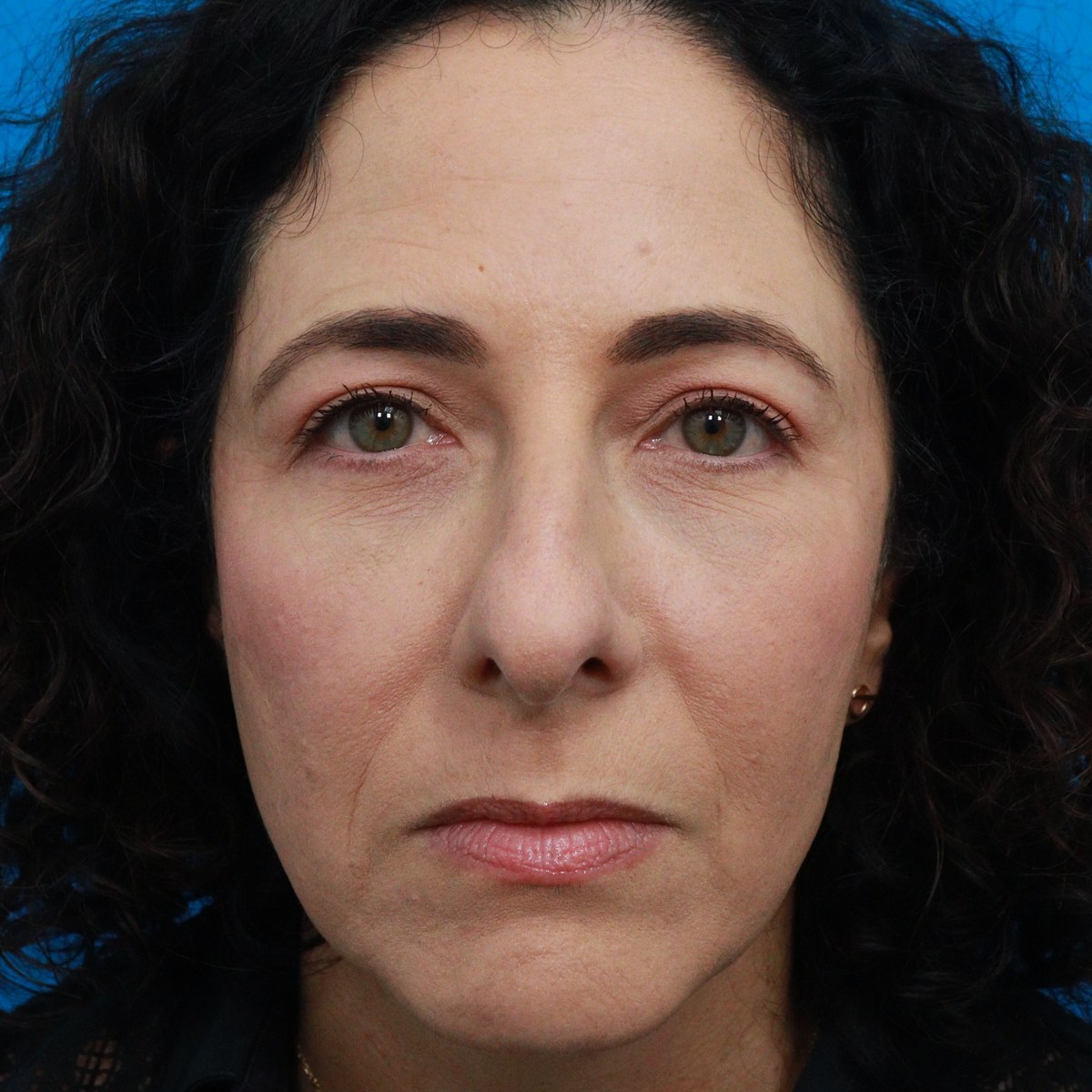 After: Upper & lower blepharoplasty with facial fat transfer