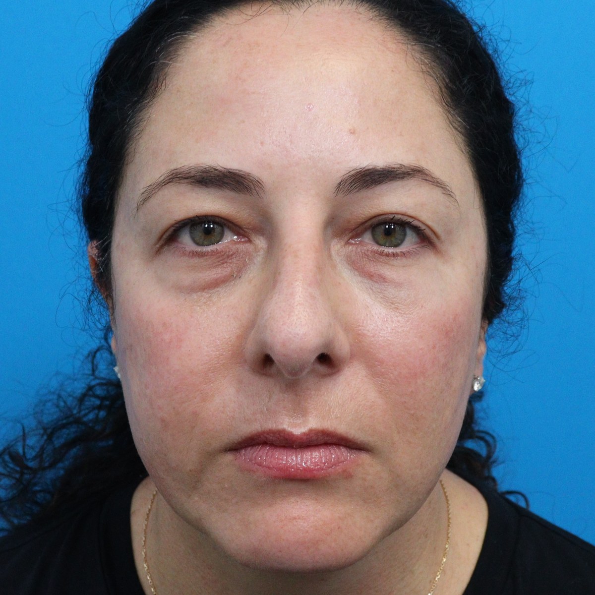 Before: Upper & lower blepharoplasty with facial fat transfer