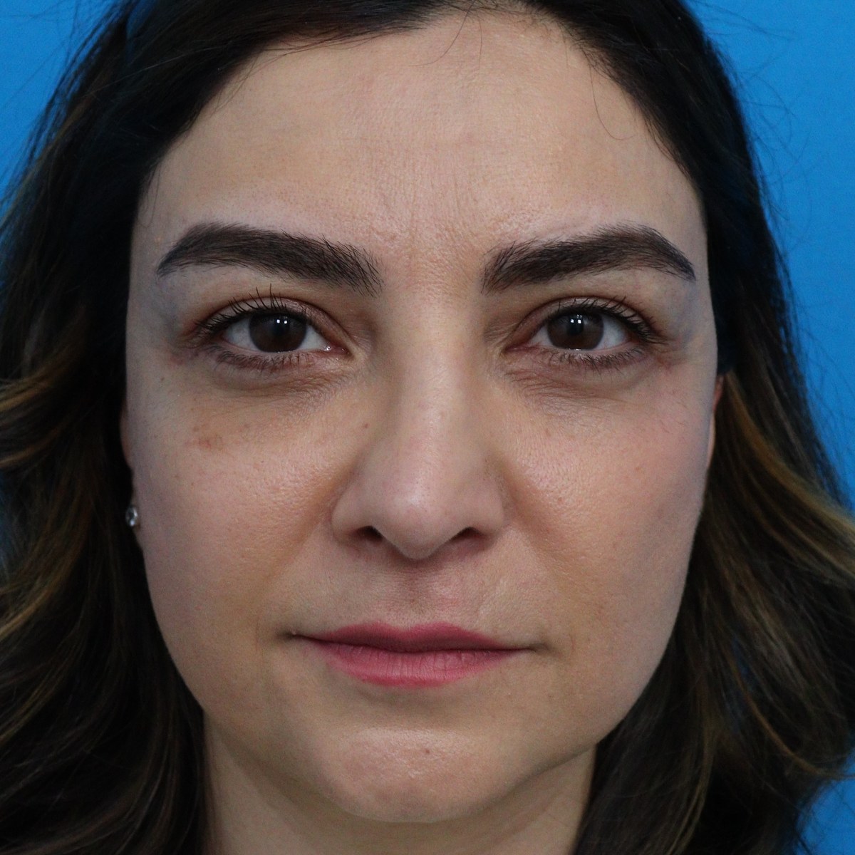 After: Lower blepharoplasty with facial fat transfer & nanofat