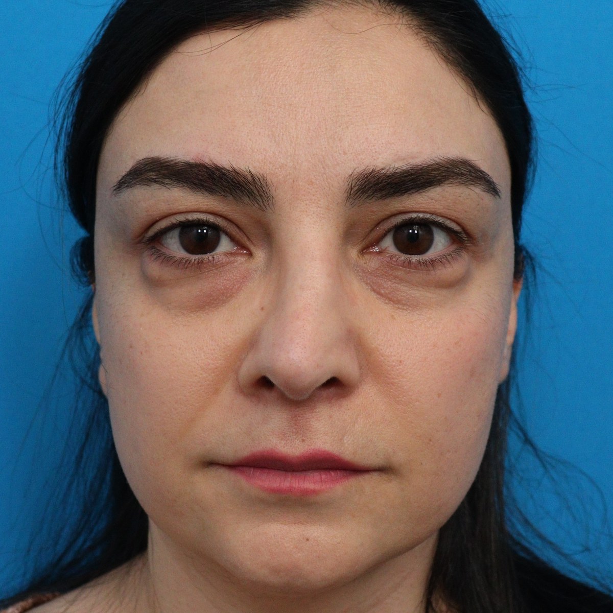 Before: Lower blepharoplasty with facial fat transfer & nanofat