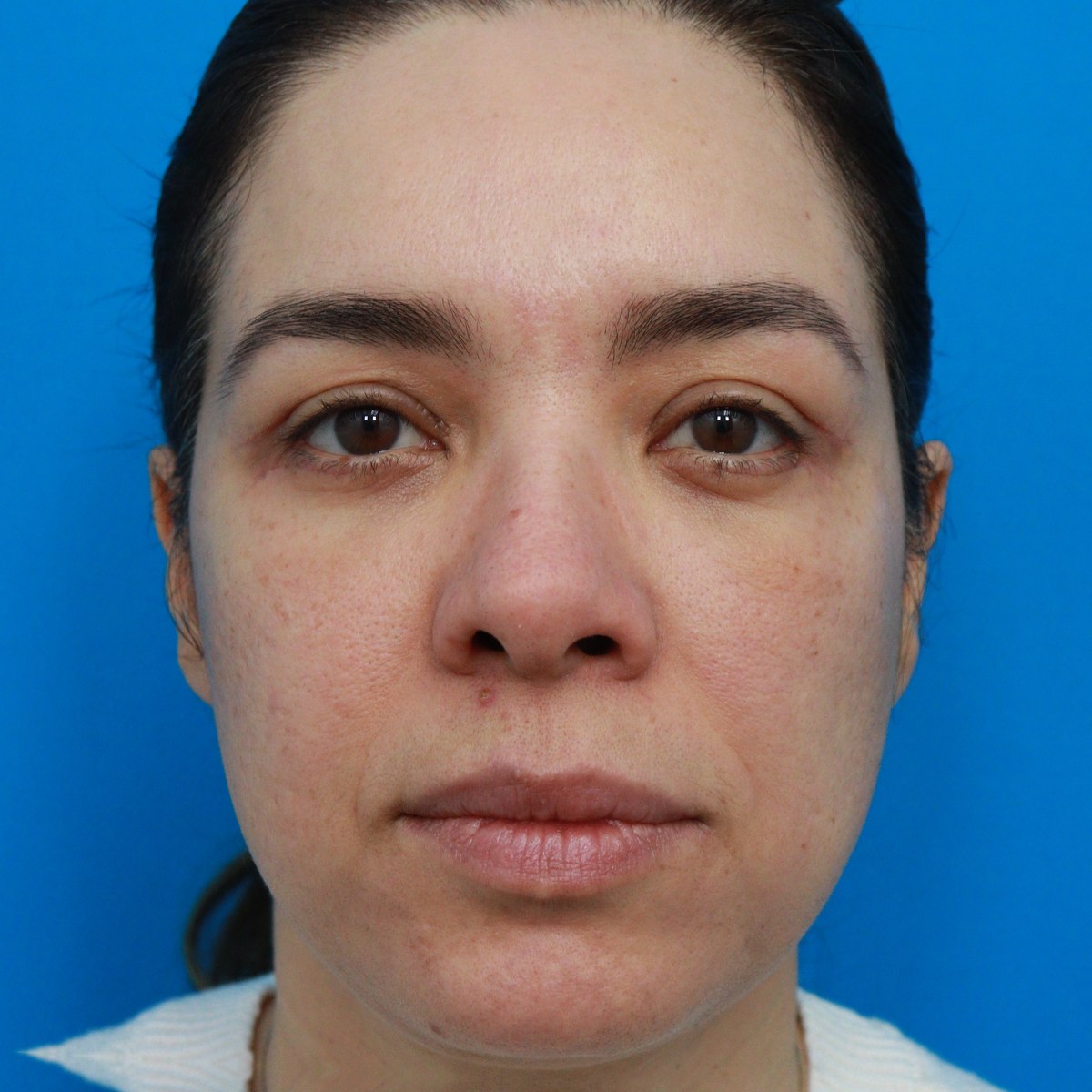 After: Upper & lower blepharoplasty with facial fat transfer & full-face nanofat