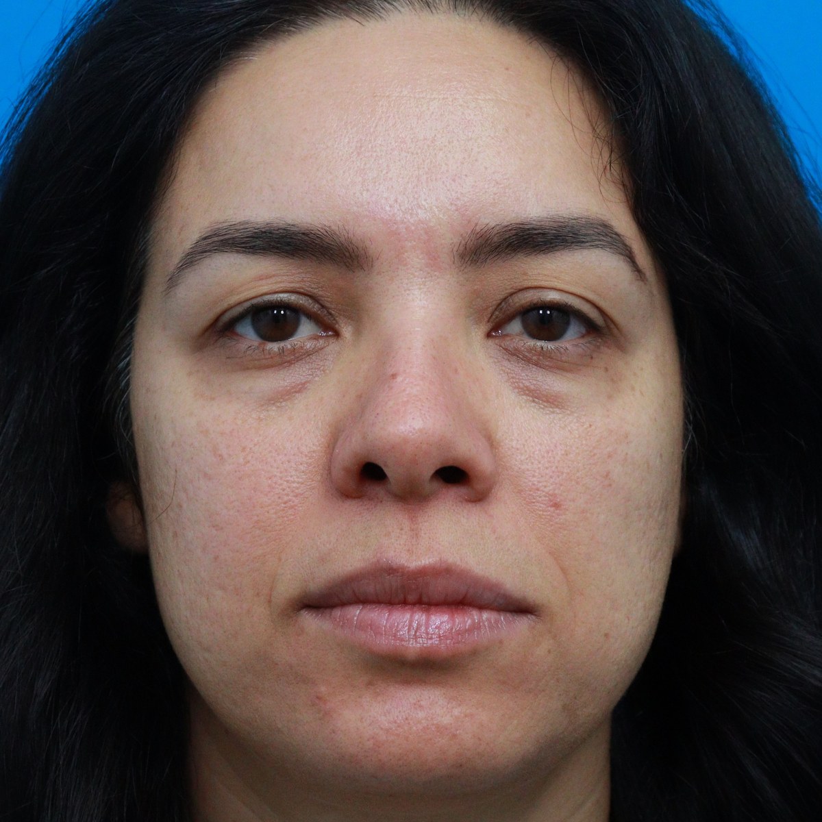 Before: Upper & lower blepharoplasty with facial fat transfer & full-face nanofat