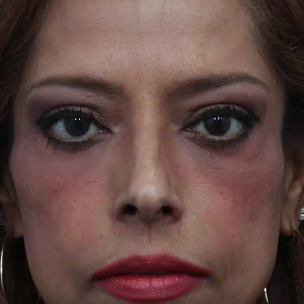 After: Upper-eyelid ptosis surgery & lower blepharoplasty with facial fat transfer
