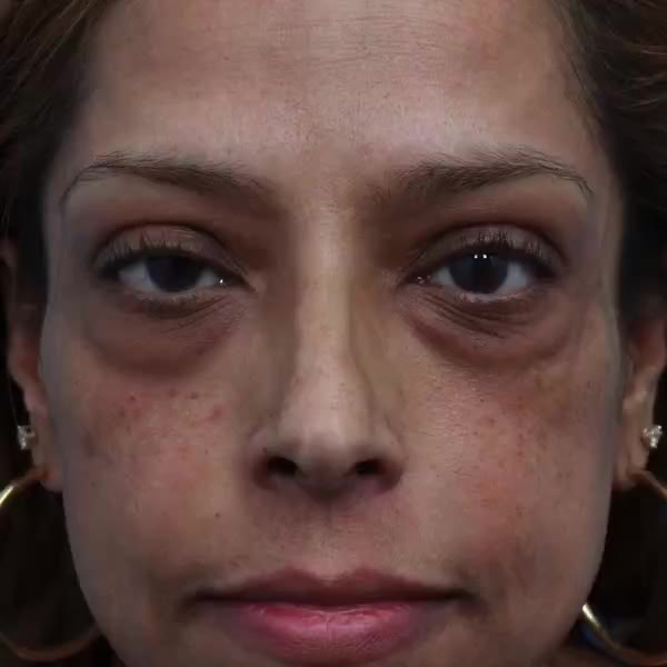 Before: Upper-eyelid ptosis surgery & lower blepharoplasty with facial fat transfer