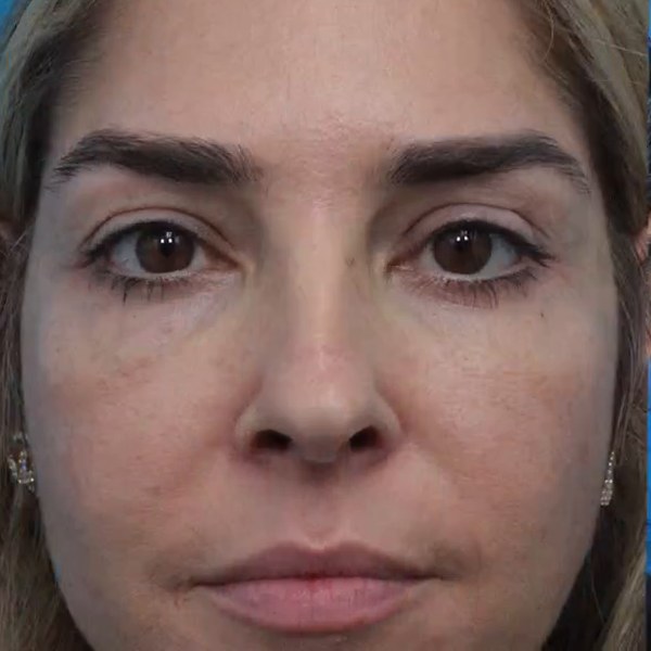 After: Lower blepharoplasty with facial fat transfer