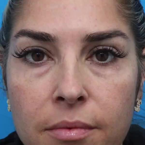 Before: Lower blepharoplasty with facial fat transfer