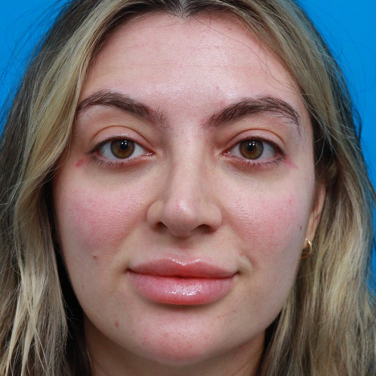 After: Lower blepharoplasty with facial fat transfer