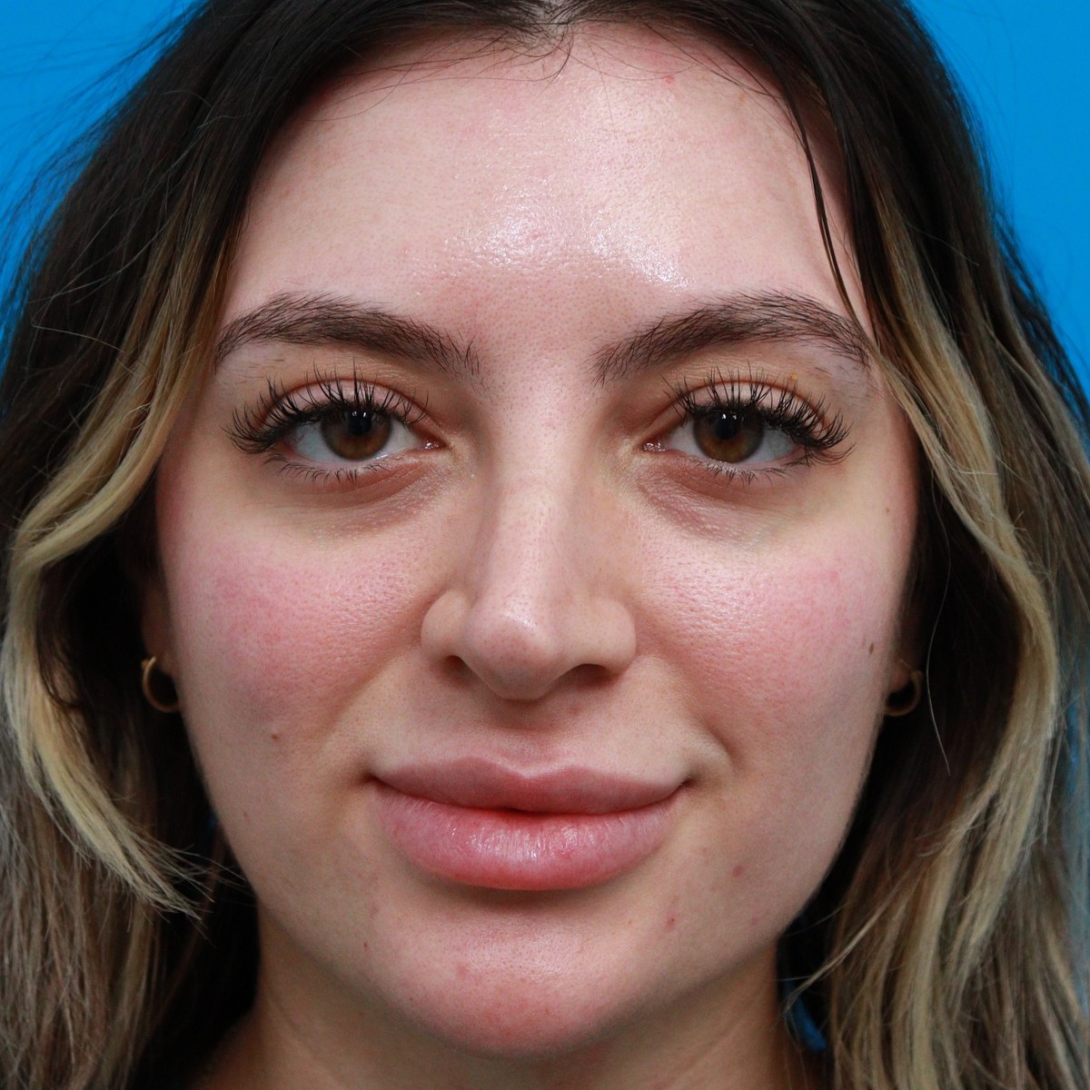 Before: Lower blepharoplasty with facial fat transfer