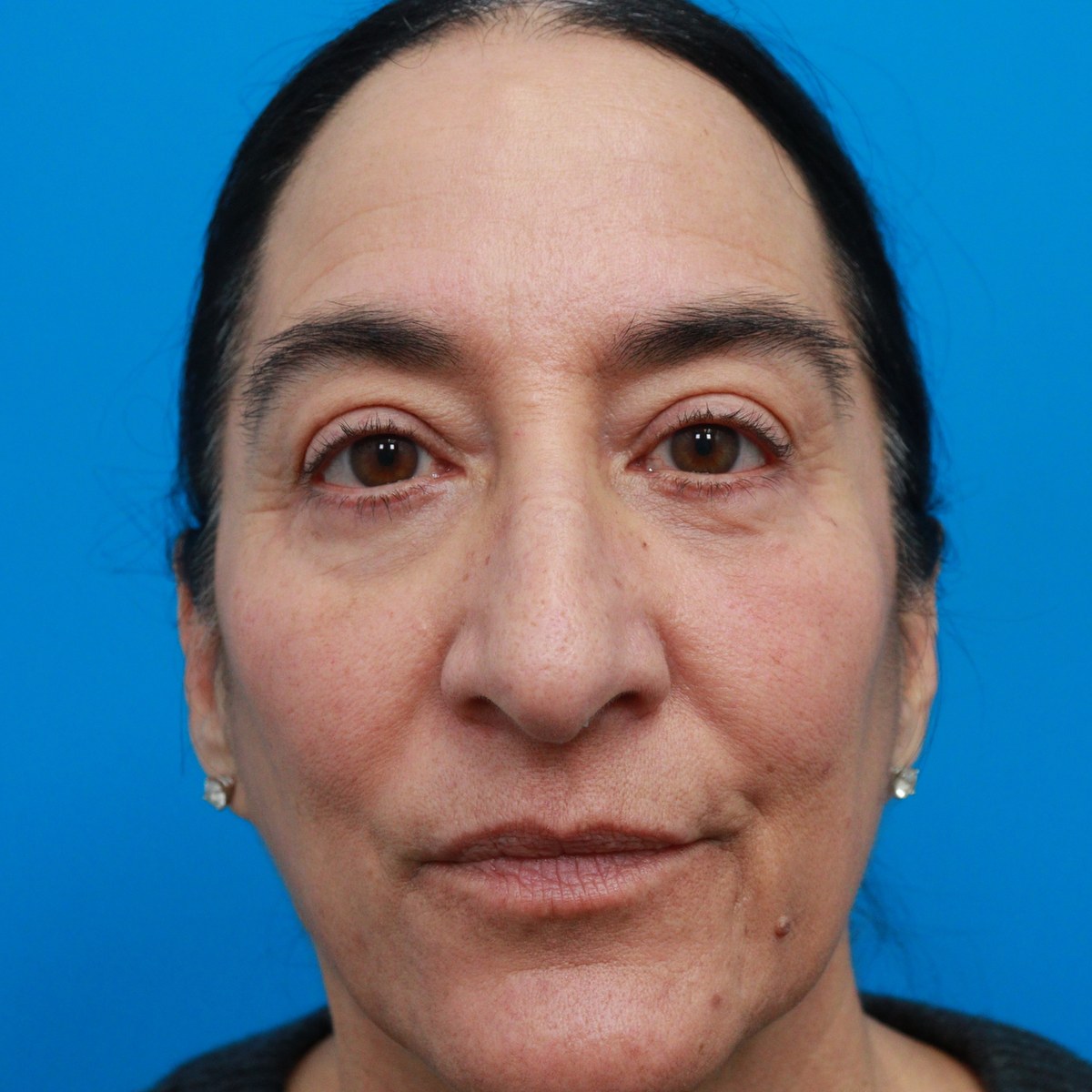 After: Lower blepharoplasty with facial fat transfer