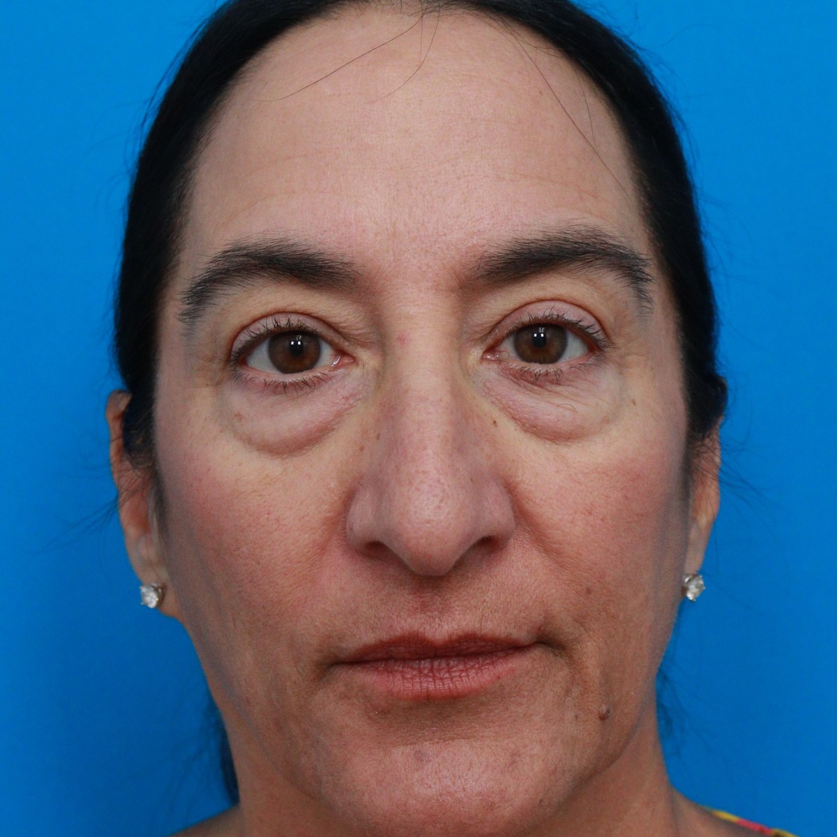 Before: Lower blepharoplasty with facial fat transfer