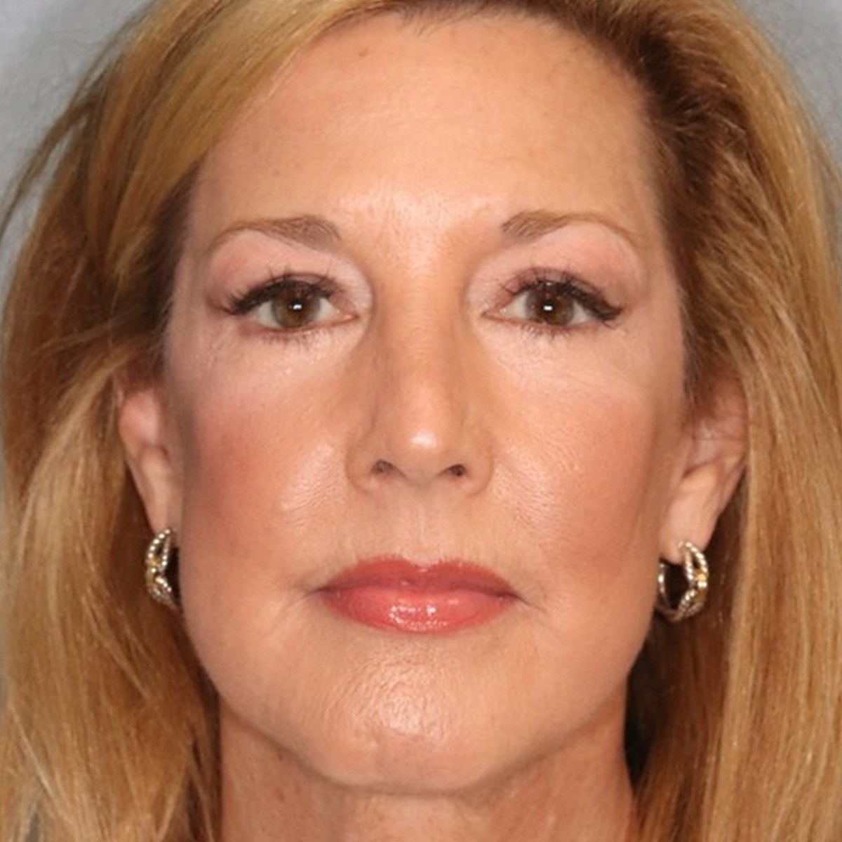 After: Endoscopic brow lift with lower blepharoplasty, facial fat transfer & CO₂ laser resurfacing