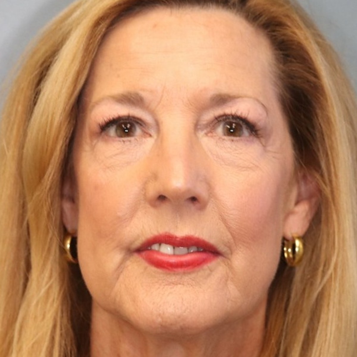Before: Endoscopic brow lift with lower blepharoplasty, facial fat transfer & CO₂ laser resurfacing
