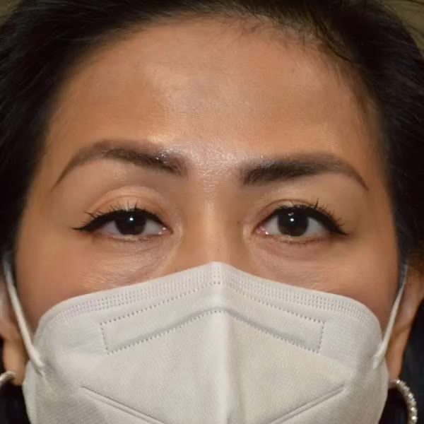 Before: Right upper-eyelid ptosis surgery