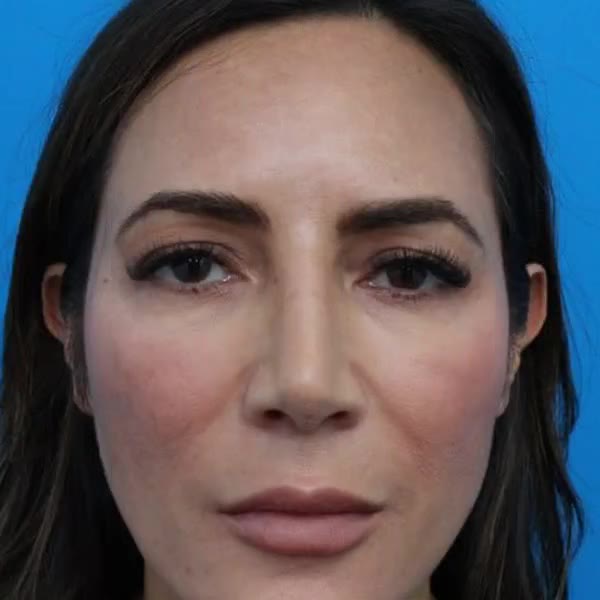 After: Upper & lower blepharoplasty with facial fat transfer