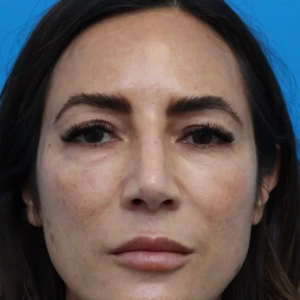 Before: Upper & lower blepharoplasty with facial fat transfer
