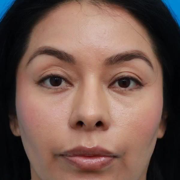 After: Lower blepharoplasty with facial fat transfer & canthopexy