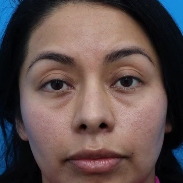 Before: Lower blepharoplasty with facial fat transfer & canthopexy