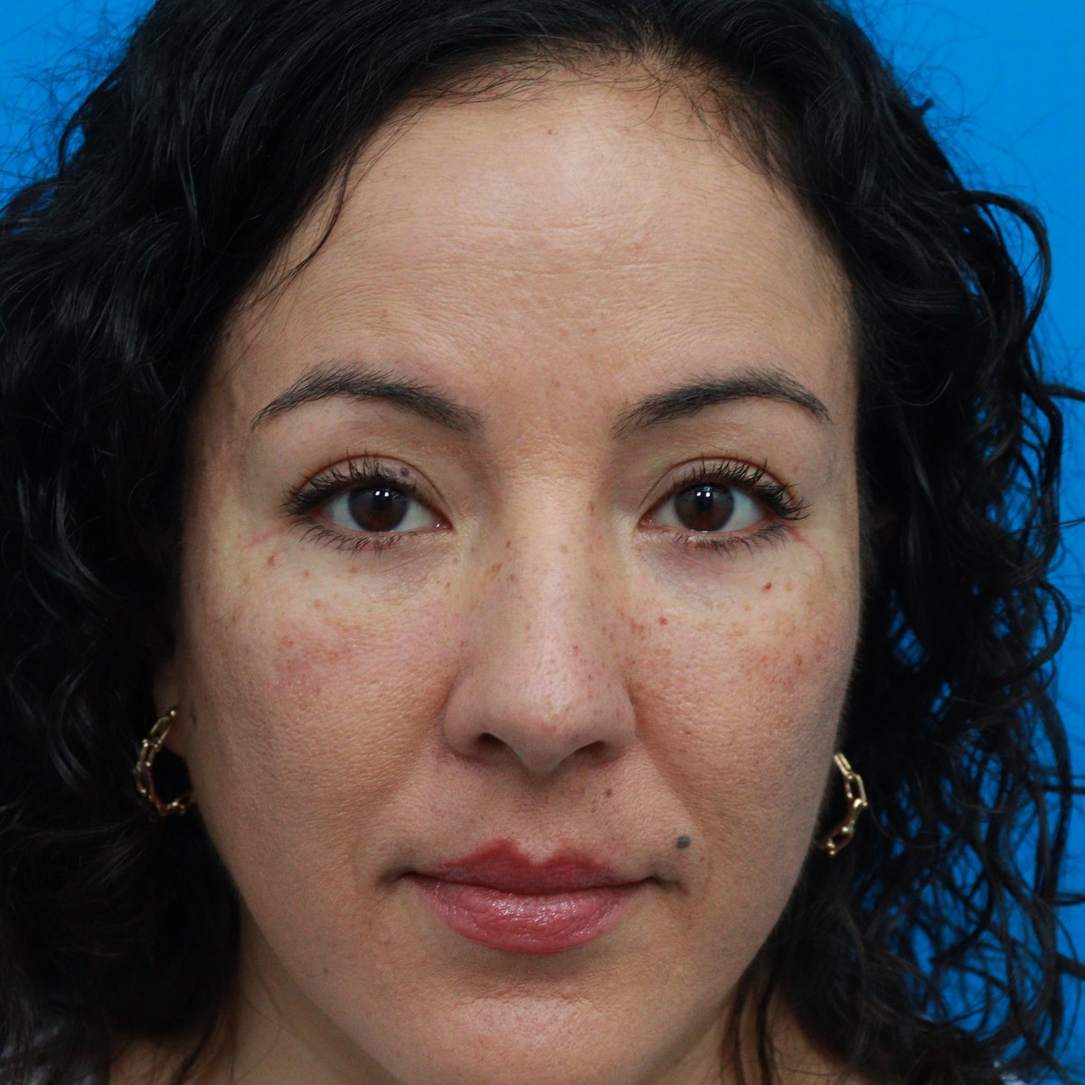 After: Lower blepharoplasty with facial fat transfer & canthopexy