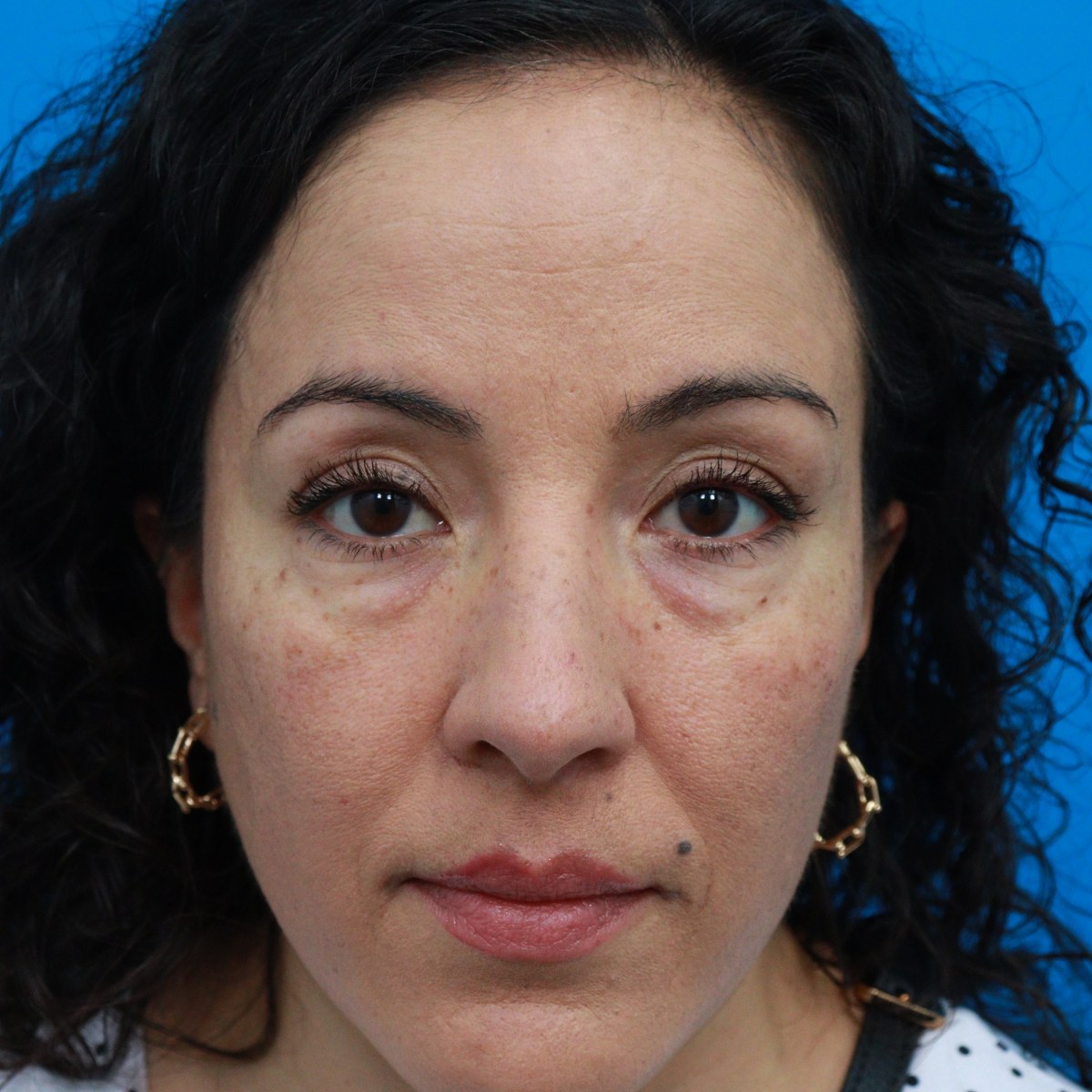 Before: Lower blepharoplasty with facial fat transfer & canthopexy