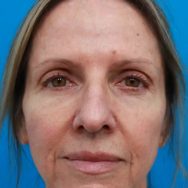 After: Lower blepharoplasty with full-face CO₂ laser skin resurfacing