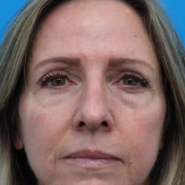 Before: Lower blepharoplasty with full-face CO₂ laser skin resurfacing