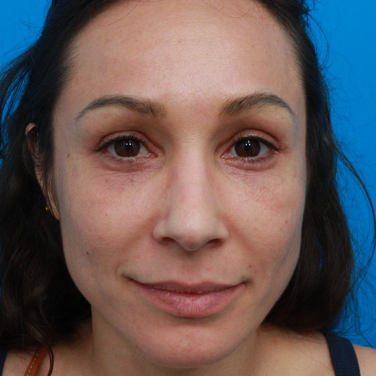 After: Upper & lower blepharoplasty with facial fat transfer & lower-eyelid CO₂ laser resurfacing
