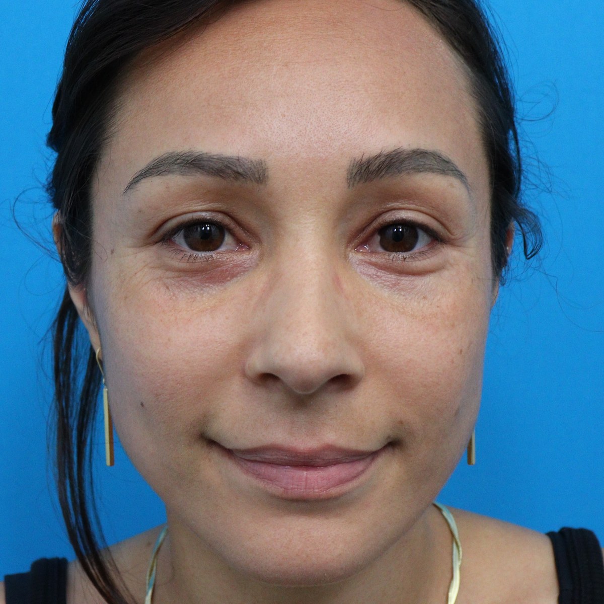 Before: Upper & lower blepharoplasty with facial fat transfer & lower-eyelid CO₂ laser resurfacing