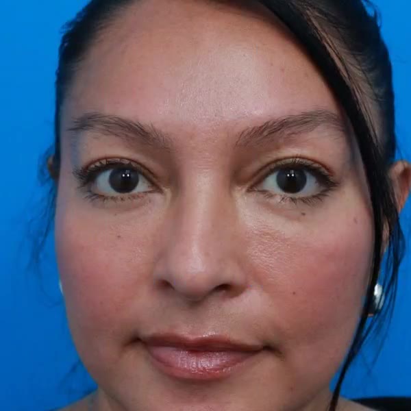 After: Lower blepharoplasty with facial fat transfer to the midface