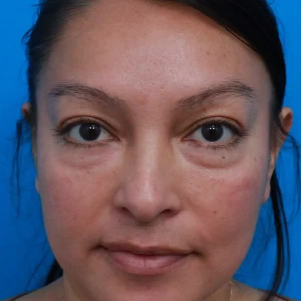 Before: Lower blepharoplasty with facial fat transfer to the midface