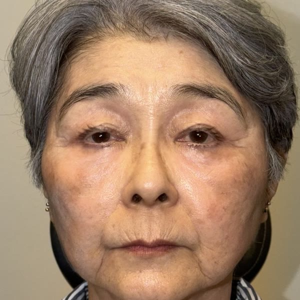 After: Ptosis surgery, upper & lower blepharoplasty with facial fat transfer