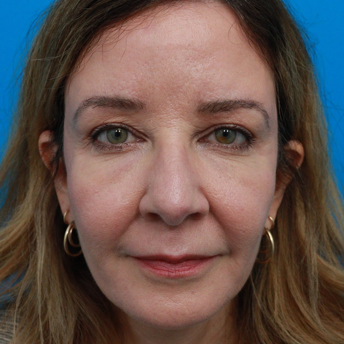 After: Upper & lower blepharoplasty with facial fat transfer & CO₂ laser skin resurfacing