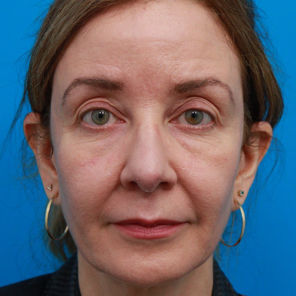 Before: Upper & lower blepharoplasty with facial fat transfer & CO₂ laser skin resurfacing