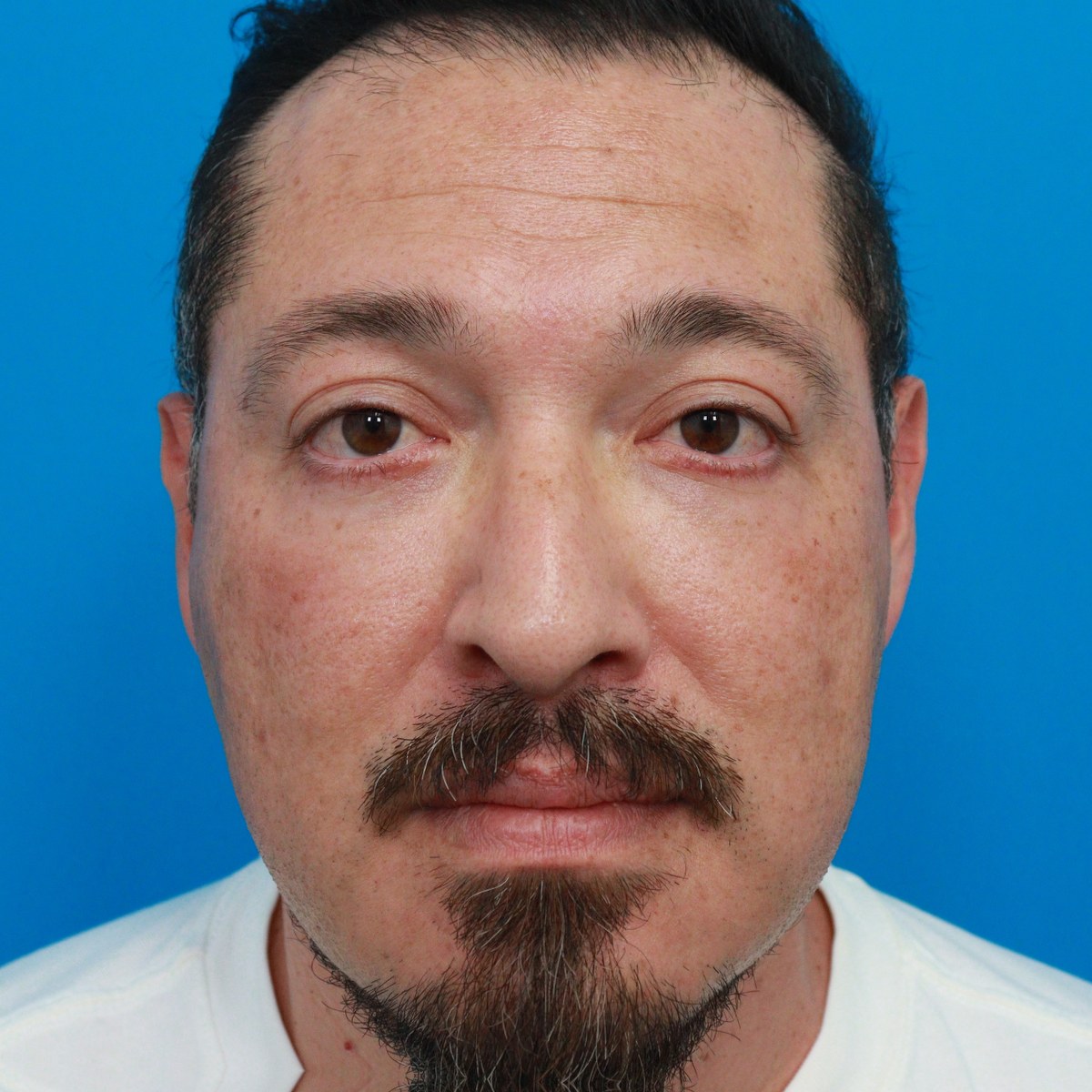 After: Lower blepharoplasty with facial fat transfer