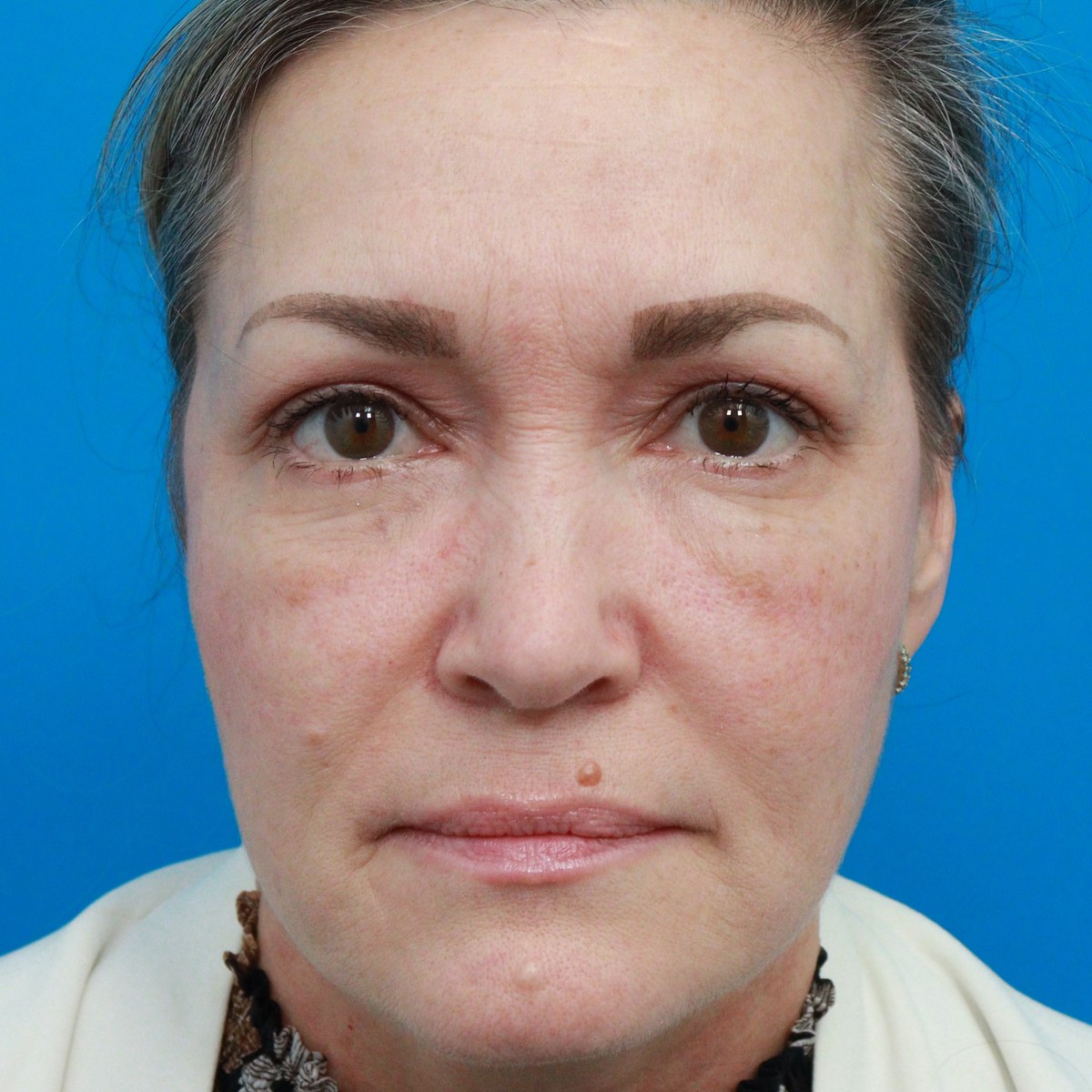After: Lower & conservative upper blepharoplasty with midface & lower-eyelid CO₂ laser resurfacing