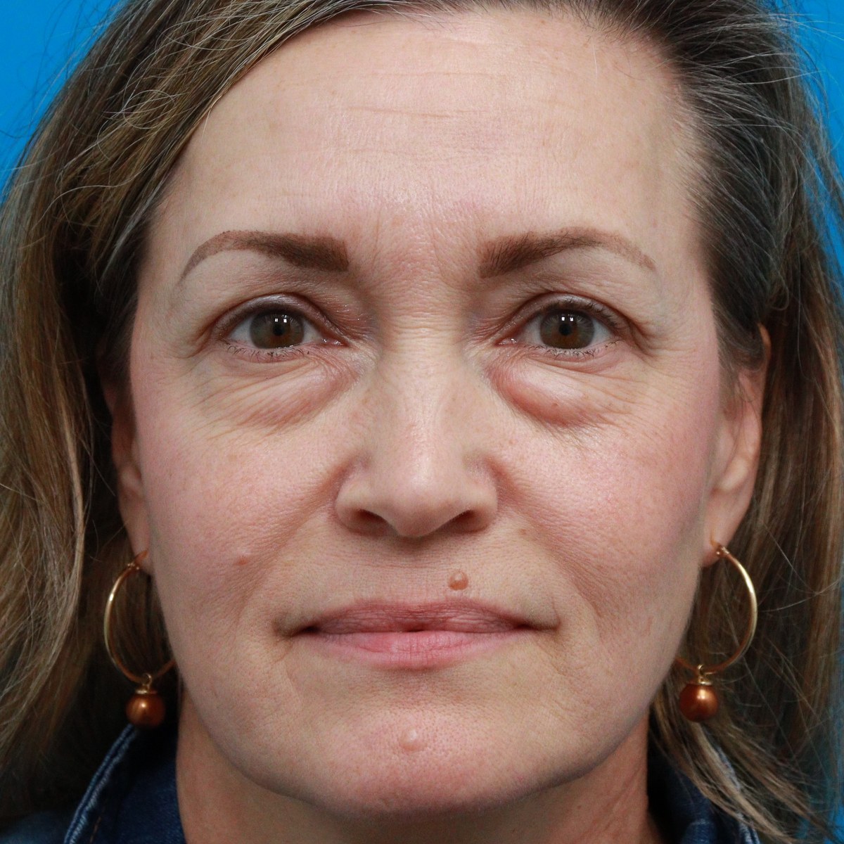 Before: Lower & conservative upper blepharoplasty with midface & lower-eyelid CO₂ laser resurfacing