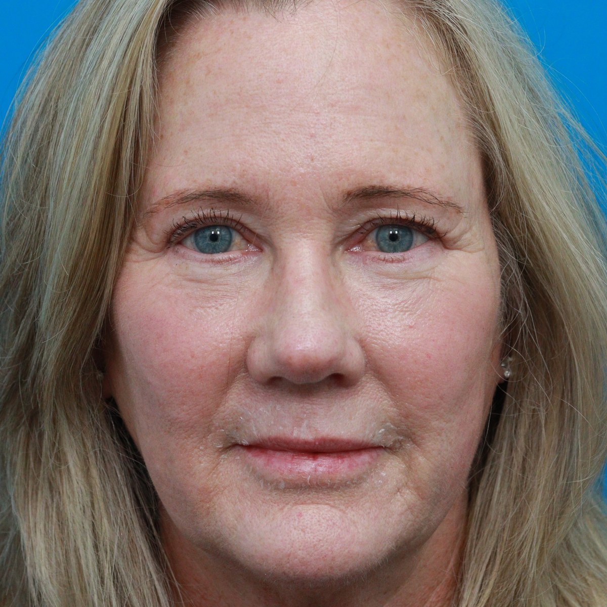After: Upper & lower blepharoplasty with facial fat transfer & full-face CO₂ laser resurfacing