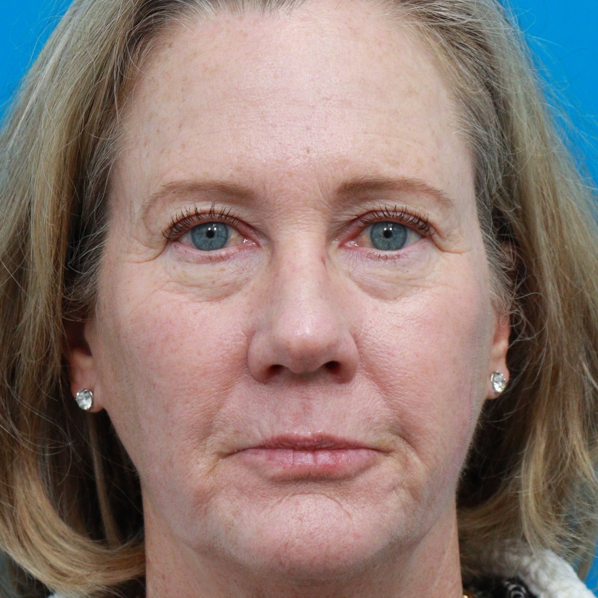 Before: Upper & lower blepharoplasty with facial fat transfer & full-face CO₂ laser resurfacing