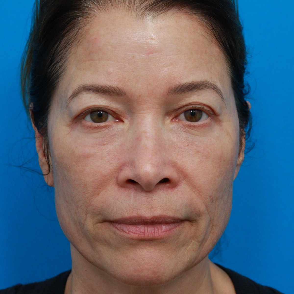 After: Upper & lower blepharoplasty with facial fat transfer & midface & lower-eyelid CO₂ laser resurfacing