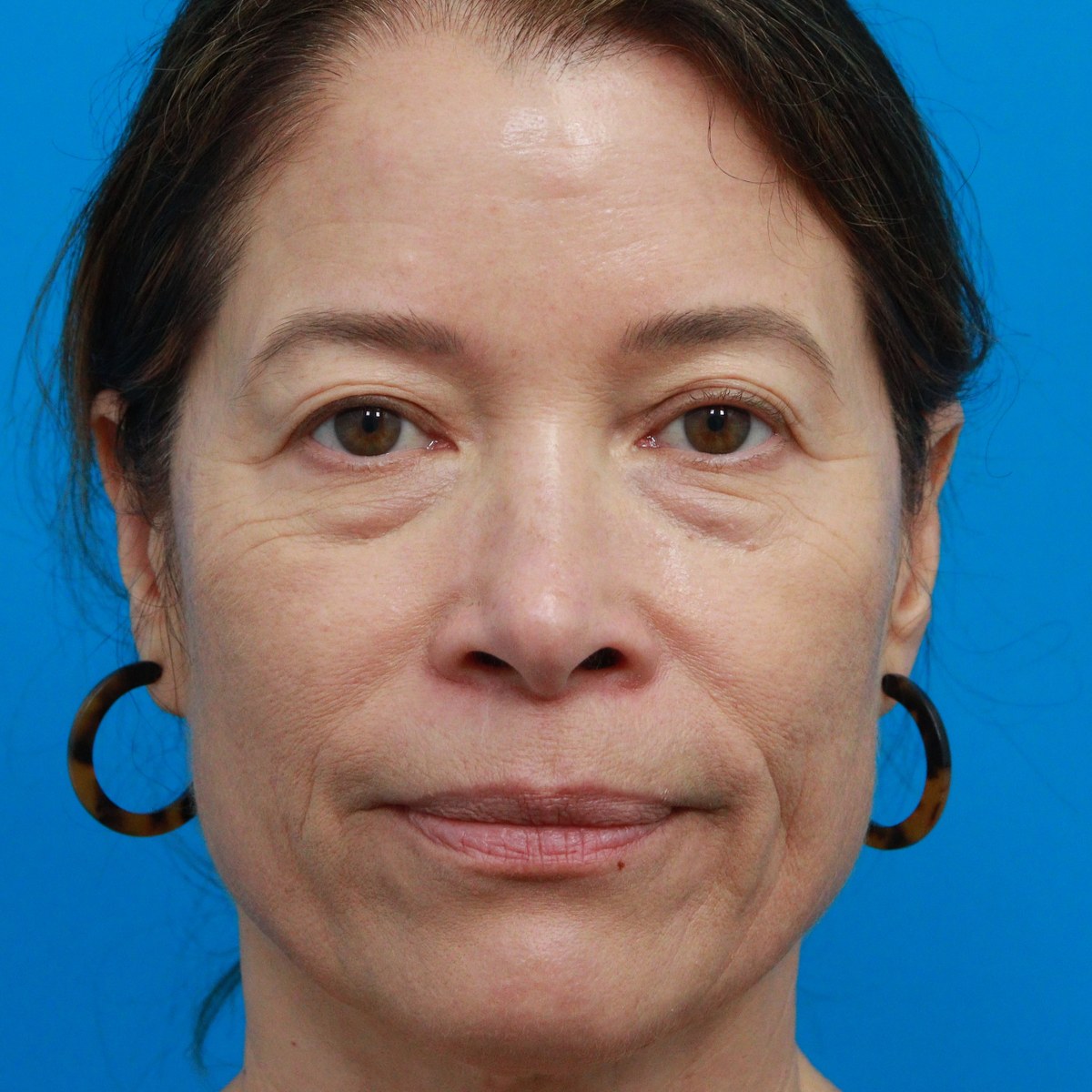 Before: Upper & lower blepharoplasty with facial fat transfer & midface & lower-eyelid CO₂ laser resurfacing